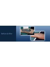 Tattoo Removal - Instant Laser Clinic