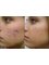 Melbourne Facials - Acne Treatments 