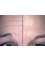 Melbourne Cosmetic Group - Before and After Treatment with Anti-Wrinkle Injections 
