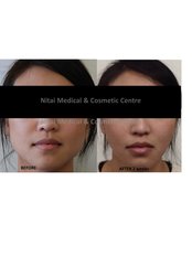 Botox™ - Nitai Medical & Cosmetic Centre
