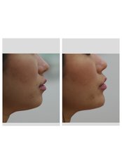 Chin Augmentation - Ohana Cosmetic Medicine