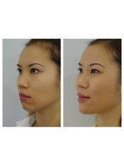 Cheek Augmentation - Ohana Cosmetic Medicine