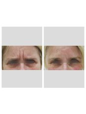 Treatment for Wrinkles - Ohana Cosmetic Medicine