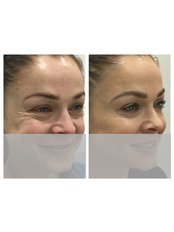 Treatment for Wrinkles - Ohana Cosmetic Medicine