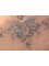 Lynn`s non-laser tattoo removal - 4/49  Church avenue, Armadale, wa, 6112,  5