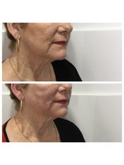Thread Nose Lift and Foxy eyes - Equinox Beauty and cosmetic clinic