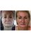 Medaesthetics Australia - Non Surgical Makeover- Thread Lift, Fat Grafting, Fraxel CO2 