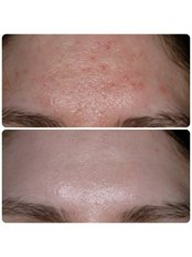 Acne Scars Treatment - Medaesthetics Australia