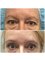 Medaesthetics Australia - Upper Eyelid Blepharoplasty & Lower Lid Laser Skin Tightening 