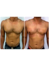 Gynaecomastia Surgery (Male Breast Gland), Before and 1 day after surgery - Medaesthetics Australia