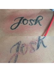 Tattoo Removal - Dynamic Skin Services