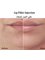 La Beaute Medical Center - Lip Filler By Dr Anisa Begaj 