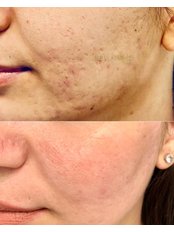 Scar Removal - Bellissimo Clinic
