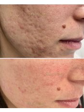 Acne Scars Treatment - Bellissimo Clinic