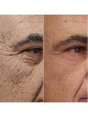 Treatment for Wrinkles - Bellissimo Clinic