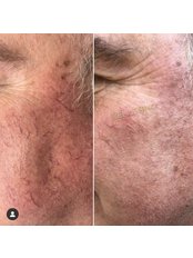 Spider Veins Treatment - Bellissimo Clinic
