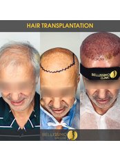 Robotic Hair Transplant - Bellissimo Clinic