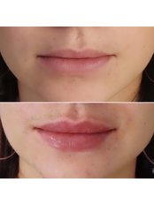 Lip Augmentation - Bellissimo Clinic