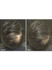 Hair Loss Treatment - Excellence Medical & Skincare Clinic, SherwoodPark