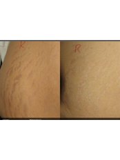 Stretch Marks Removal - Excellence Medical & Skincare Clinic, SherwoodPark