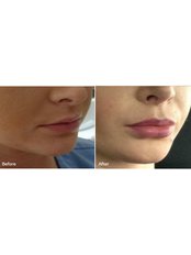  lips augmentation  - Excellence Medical & Skincare Clinic, SherwoodPark