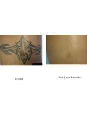 Tattoo Removal - Excellence Medical & Skincare Clinic, SherwoodPark