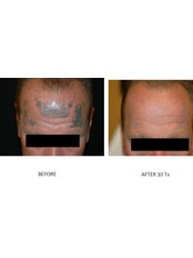 Tattoo Removal - Excellence Medical & Skincare Clinic, SherwoodPark