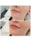 Horizon Vein and Cosmetic Centre - Lip Augmentation 