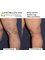 Horizon Vein and Cosmetic Centre - Sclerotherapy before/after 