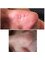 Horizon Vein and Cosmetic Centre - Dermapen, Micro needling, Scar treatment 