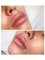 Horizon Vein and Cosmetic Centre - Lip Filler 