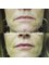 Skin Deep Aesthetics - subtle volume to soften the mature lip 