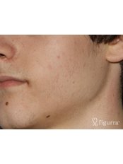 Acne Treatment - Figurra