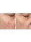 Skin Vitality Medical Clinic - Ajax - Clear-Brilliant Before & After  