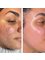 Skin Vitality Medical Clinic - Ajax - Morpheus Before & After 
