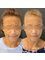 Skin Vitality Medical Clinic - Ajax - Wrinkle Reduction 