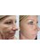 Skin Vitality Medical Clinic - Ajax - Skin Before & After  