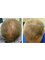 Skin Vitality Medical Clinic - Ajax - Hair Before & After 