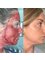 Skin Vitality Medical Clinic - Ajax - Facial Rejuvenation Before & After  