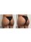 Skin Vitality Medical Clinic - Ajax - Nonsurgical Butt Lift Before & After  