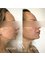 Skin Vitality Medical Clinic - Burlington - Chin Dermal Filler 