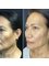 Skin Vitality Medical Clinic - Burlington - Morpheus Before & After 