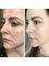 Spa Luxe Med Spa - Plasma facial results before & after 