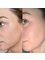 Spa Luxe Med Spa - Chemical Peel Removes Brown Spots/Sun Damage 