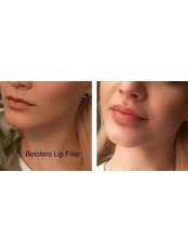 Lip Augmentation - Spa Luxe Med Spa