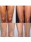 Spa Luxe Med Spa - Cellulite Legs Results 