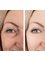 Spa Luxe Med Spa - Under Eye Filler Restores Age Related Collagen Loss & Hides Dark Circles 