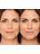 Spa Luxe Med Spa - Facial Filler Reduces Smile Lines (Nasolabial Folds) 