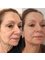 Spa Luxe Med Spa - Thread lift skin tightening results 