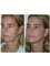 Spa Luxe Med Spa - Thread Lift Treatment Before & After 
